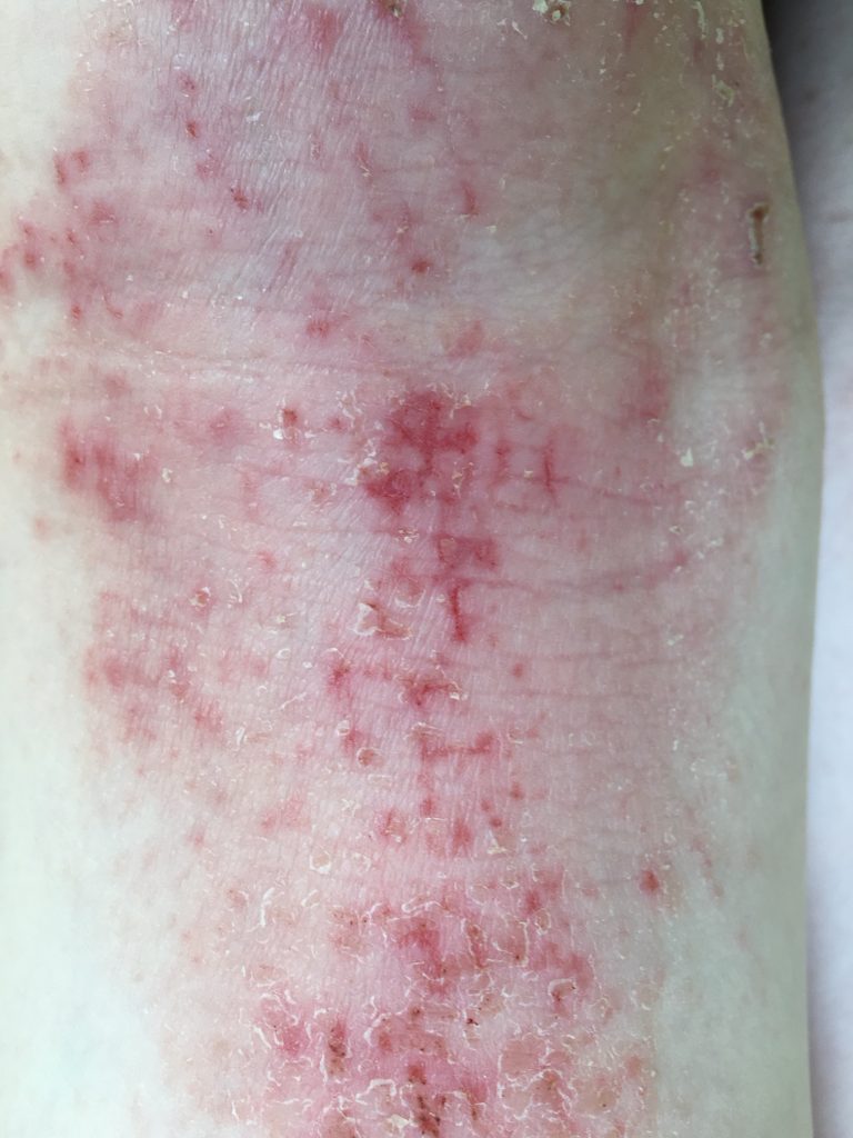 Patient 1 Kniekehle Neurodermitis vor Behandlung mit Madena Darmkur