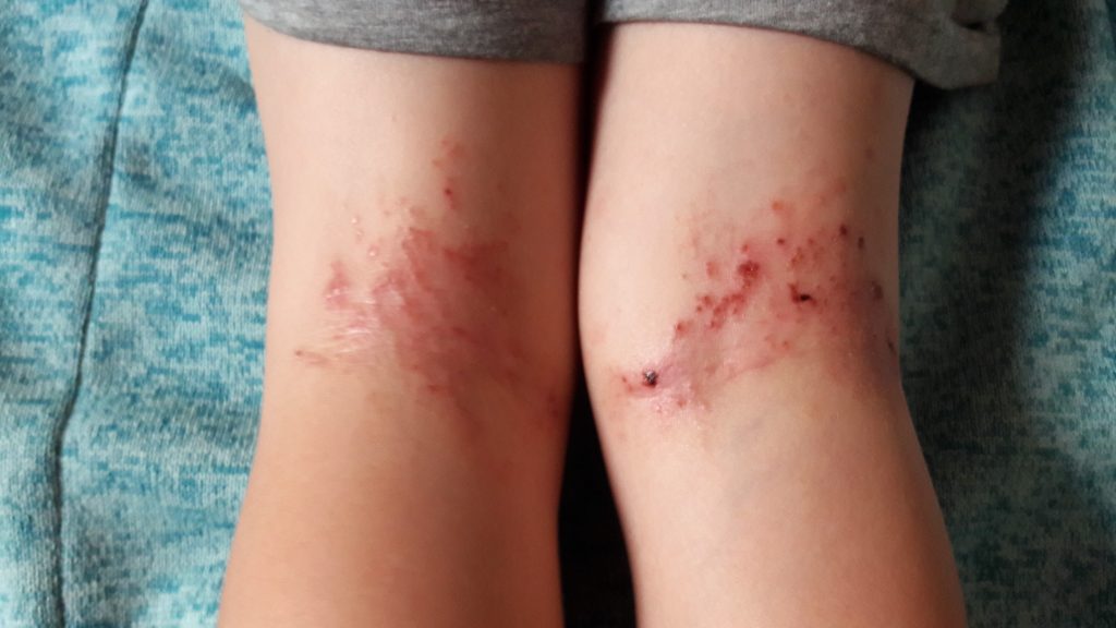 Patient 2 Kniekehle Neurodermitis vor Behandlung mit Madena Darmkur