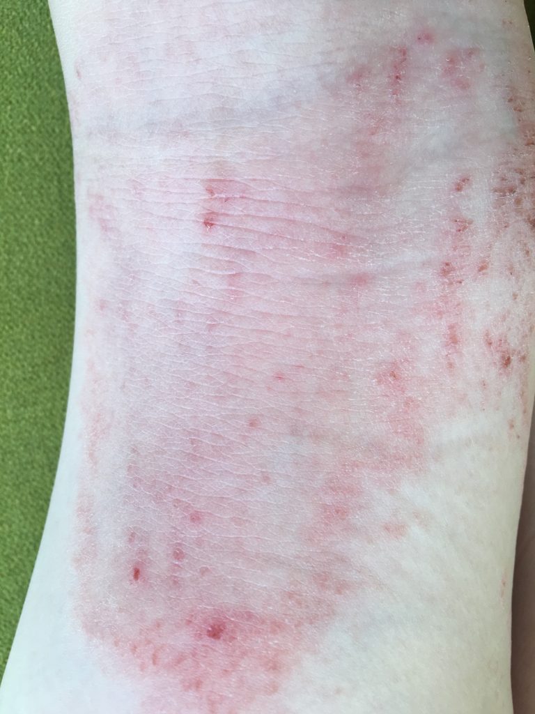 Patient 1 Kniekehle Neurodermitis nach einer Woche Behandlung mit Madena Darmkur